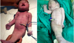 Em bé sơ sinh bị mắc dị tật dính liền chân giống như người cá trong truyền thuyết