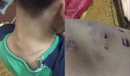 Bé trai 9 tuổi bị bố đẻ dùng dây điện đánh thâm tím cơ thể