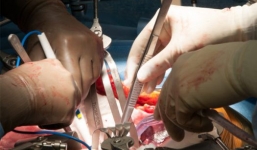 Hy hữu: Phẫu thuật xong bác sĩ khắc tên mình lên gan bệnh nhân