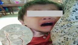 Hãi hùng giun sán dài nửa mét bò ra từ... miệng các em nhỏ