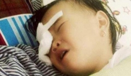 Xót xa bé gái 2 tuổi bị gà chọi đá mù mắt