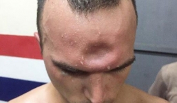 SỐC: Võ sĩ Muay Thái lõm trán kinh hoàng sau cú thúc chỏ của đối thủ