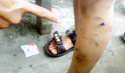 Quấy phá hàng xóm, bé trai 6 tuổi bị cha đánh thương tích khắp người