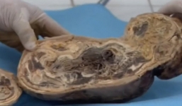 Người phụ nữ mang bầu suốt 46 năm 'không chịu đẻ', bác sĩ sốc nặng khi lấy bào thai ra