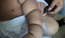 Con mới sinh tay chân đã có nhiều ngấn, bố toát mồ hôi khi bác sĩ nói để muộn phải cắt bỏ