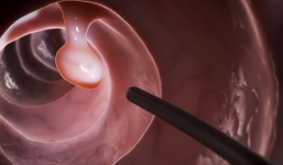 4 nhóm người buộc phải khám ung thư để tiêu diệt mầm bệnh ngay từ trong 'trứng nước'