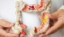 GĐ Trung tâm Ung bướu: Dấu hiệu sớm của ung thư đại trực tràng khi đi ngoài bạn cần chú ý