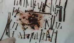 Cụ bà U80 sợ thiếu máu, nuốt 152 đinh vít để bổ sung sắt