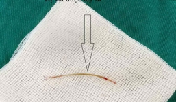 Cụ bà 72 tuổi ở Hà Nội suýt chết do xương cá đâm thủng ruột