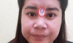 Nâng mũi giá rẻ, cô gái bị miếng silicone lòi hẳn ngoài sống mũi, nhô ra giữa hai mắt