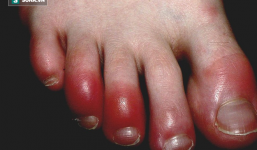 Căn bệnh mùa đông nhiều người mắc sẽ nguy hiểm tính mạng nếu có 4 dấu hiệu nhiễm trùng sau