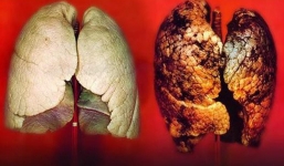 Không hút thuốc lá mà vẫn bị ung thư phổi, chuyên gia xác nhận đây chính là 'thủ phạm'