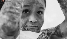 Xót xa những vết bỏng đau đớn trên người bé trai 6 tuổi: Ngày con phải cưa chân là ngày bạn bè vào lớp 1