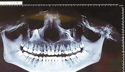 Thấy đau ở mặt khi nhai thức ăn, người phụ nữ đi khám mới phát hiện sự thật kinh hoàng