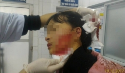 Nữ sinh bất ngờ bị đâm rách 14cm ở mặt do mâu thuẫn vì bán quần áo trên mạng