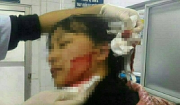 Mới nhất vụ nữ sinh 16 tuổi bị rạch mặt: Phải khâu gần 40 mũi