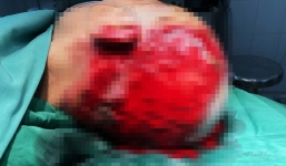 Một phụ nữ Gia Lai hoại tử da đầu nặng, vĩnh viễn không thể mọc tóc sau sự cố làm đẹp kinh hoàng