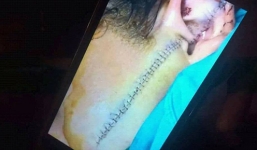 Mới nhất vụ nữ sinh 16 tuổi bị rạch mặt: Khởi tố vụ án