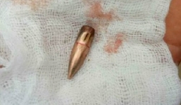 Đang làm đồng bất ngờ bị đạn chì găm vào người