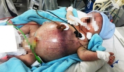 Tưởng không thể qua khỏi, bé trai thủng ruột từ trong bụng mẹ được cứu sống kỳ diệu