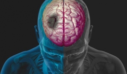 Có thể bị đột quỵ do trời rét đậm: Đây là cách phòng ngừa ai cũng nên làm ngay