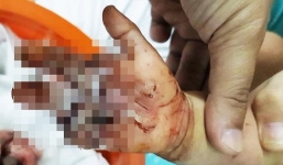 Bé trai 2 tuổi bị xích xe máy cuốn đứt lìa bàn tay