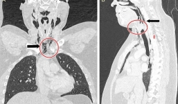 Người đàn ông bị vỡ cổ họng, thủng màng nhĩ vì cố nhịn hắt hơi