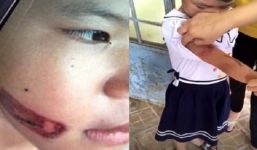 Vụ bé gái nghi bị bố và mẹ kế dí sắt nung vào mặt: Đã có quyết định khởi tố mẹ kế, nhưng chưa thể thực hiện