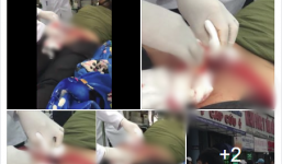 Tai nạn hy hữu: Ngồi xổm làm sập bồn cầu, nam thanh niên bị các mảnh sứ cứa rách phần mông sâu đến tận xương cụt