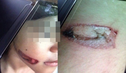 Mới nhất vụ bé gái bị cha dí thanh sắt nóng vào mặt