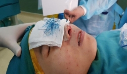 Cô gái trẻ hoảng hồn khi thấy mũi hoại tử xanh lè sau dao kéo