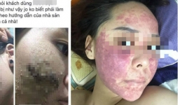 Khuôn mặt đáng sợ của cô gái khiến chị em dè chừng với mỹ phẩm không rõ nguồn gốc