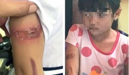 Chính quyền xã phải chịu trách nhiệm vụ bé gái bị bố đẻ và mẹ kế dí sắt nóng vào mặt 'biến mất'