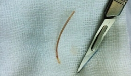 TP.HCM: Cụ bà 77 tuổi bị thủng ruột vì ăn cá 'quên' nhả xương