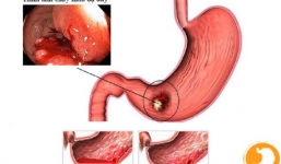 Cảnh báo biến chứng nguy hiểm của bệnh dạ dày, đại tràng: Chủ quan có ngày mất mạng