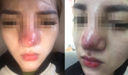 Ký ức ám ảnh của cô gái khi thực hiện nâng mũi bằng chỉ vàng 24K