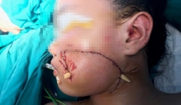 Bé gái 8 tuổi chơi đùa với chó nhà bị cắn nát mặt