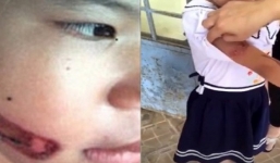 Thông tin mới nhất vụ bé gái nghi bị bố đẻ và mẹ kế dí sắt nóng vào mặt