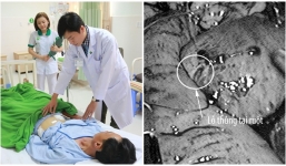 Đánh nhau trên bàn nhậu, người đàn ông bị bạn dùng đũa đâm thủng ruột