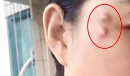 Cô gái trẻ mọc khối u lạ trên mặt sau khi trải qua quá trình phẫu thuật thẩm mỹ giá rẻ