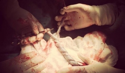 Hi hữu ca sinh đôi có 2 dây rốn xoắn như tết tóc