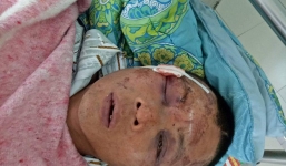 Người đàn ông nghi bắt cóc bé gái 14 tuổi bị đánh biến dạng mặt, gãy toàn bộ răng