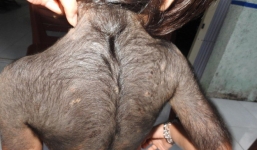 Bé gái bỗng dưng mọc lông đầy người sau khi uống thuốc biếng ăn