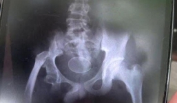 Cậu bé khẳng định 'đẻ' ra 20 quả trứng gà trong suốt 2 năm qua