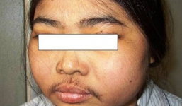 Loại thuốc độc gây suy thận nhưng rất nhiều người Việt coi là 'thần dược' chữa bách bệnh