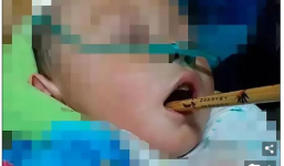 Cảnh báo: Bé trai 2 tuổi hiếu động bị đũa gỗ đâm vào miệng xuyên lên sọ não