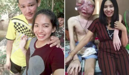 Dù chồng bị ung thư với khuôn mặt biến dạng, vợ vẫn một lòng ở bên chăm sóc: '3 năm, em vẫn yêu anh như ngày đầu'