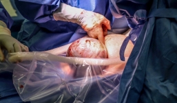 Hiếm thấy trong 80.000 ca sinh: bé gái chào đời với màng ối trùm quanh đầu