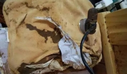 Gối sưởi phát nổ trong đêm, nam ca sĩ có nguy cơ bị hủy hoại sự nghiệp sau khi mặt bị bỏng nghiêm trọng