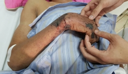 Tiếp xúc với lợn 'bẩn', 9 người nhiễm khuẩn liên cầu lợn nhập viện trong tình trạng nguy kịch